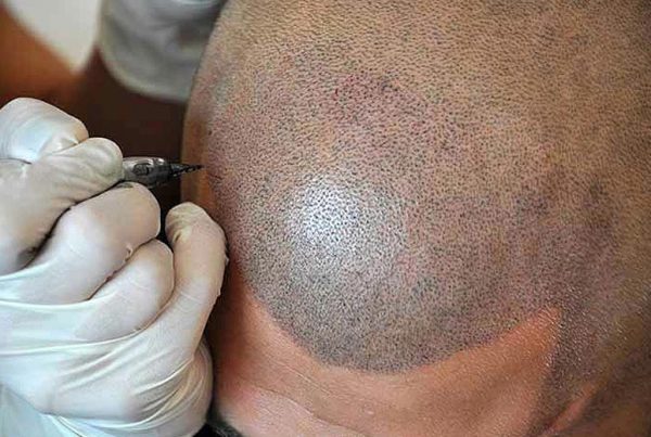 Photo of a men's top scalp getting scalp micropigmentation known as SMP