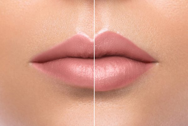 female lips after lip augmentation